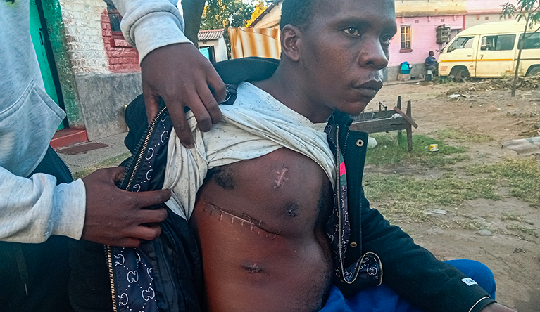 Rodric Tore shows his healing scars after doctors removed a metal piece out of his body in Highfield, Harare, Zimbabwe on 06 May 2026. Photograph Enos Denhere / SA I AJP